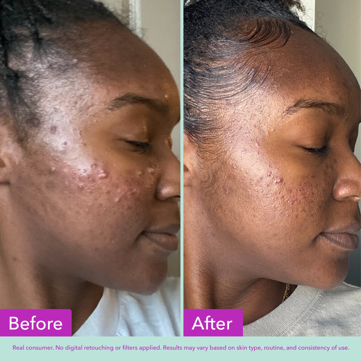 acne-foaming-cleanser-c4 zb_p.jpg