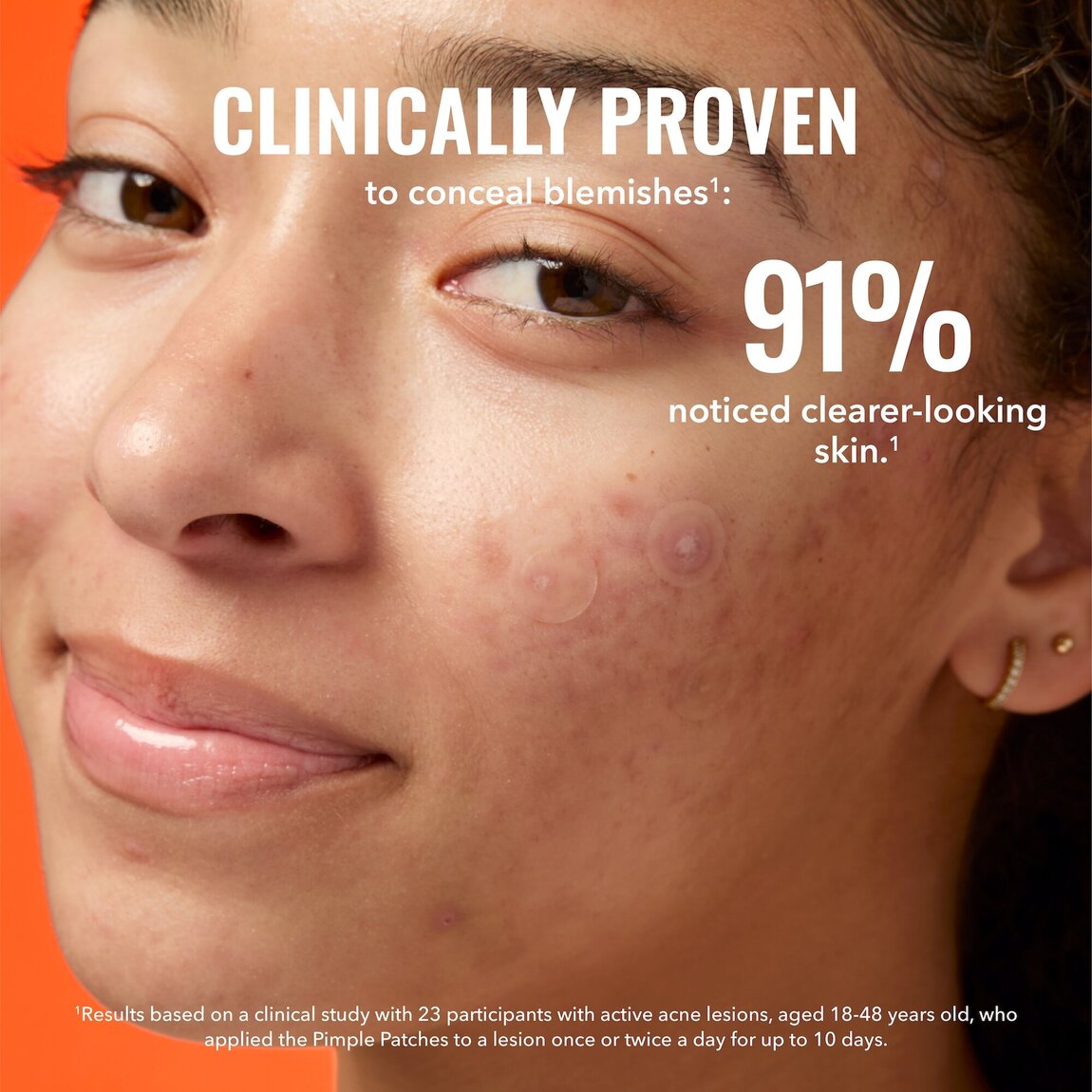 pimple-patches-z2 zb_p.jpg